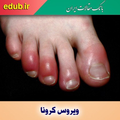 انگشت پای کوویدی و علت ایجاد آن